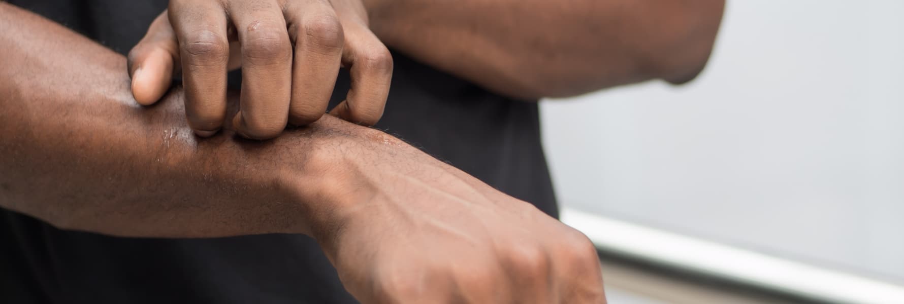 Rashes Treatment Plantation FL